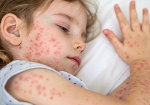 A resting child with red bumps all over their face and arms.